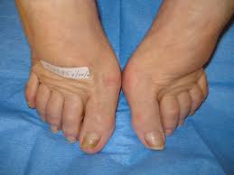 laser treatment for toenail fungus in