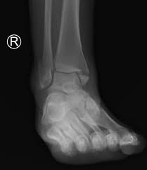 Ankle fracture (peds) tillaux fracture; Ankle Fractures Core Em