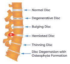 herniated disc surgery in new jersey
