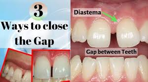 Occasionally, a removable retainer can be used to fix gaps between teeth. Gap In Front Teeth What To Do Diastema How To Fix A Teeth Gap With O Fix Teeth Gap Teeth Cavity On Front Tooth