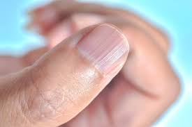 ridges in fingernails causes and