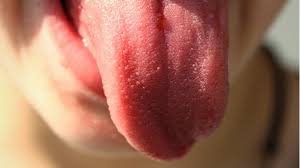 Pain while eating or swallowing 6. Pilz Auf Der Zunge Ursachen Symptome Und Behandlung Focus De