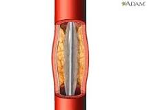 Image result for icd 10 code for history of ptca stent