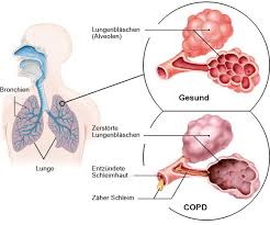 What is chronic obstructive pulmonary disease? Chronisch Obstruktive Lungenerkrankung Copd