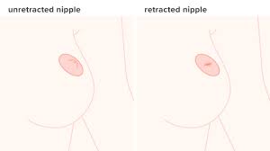 Erection of nipple