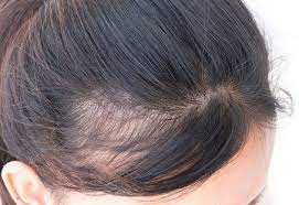 pcos hair loss causes 8 effective