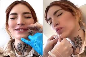 lip filler removal process and lip
