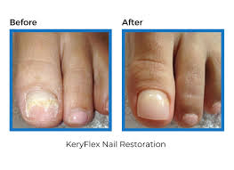 keryflex nail restoration system