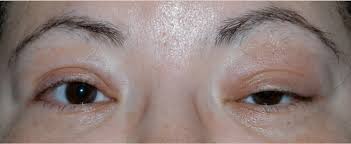 sarcoidosis affecting the lacrimal gland