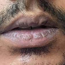 smoker s lips treatment in riyadh