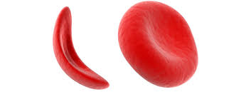 Image result for sickle cell