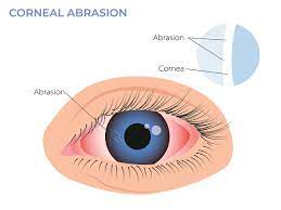 corneal abrasions santa monica eye group