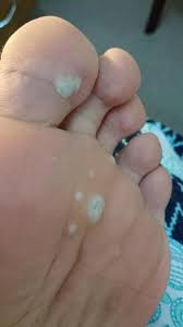 Pictures and videos about cysts and pimples. My Plantar Warts Removed Album On Imgur