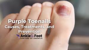 purple toenails causes treatments