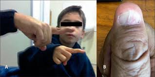 nail patella syndrome