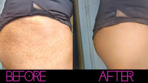 how to hide stretch marks 2 simple