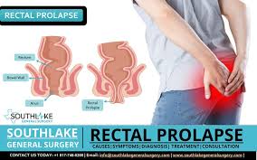 rectal prolapse diagnosis symptoms