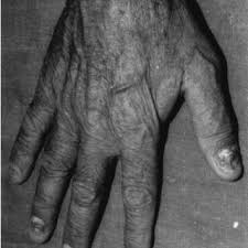 e quadrilineata showing nail dystrophy