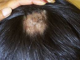 How can a fungal infection cause hair loss? Tinea Capitits Dermnet Nz