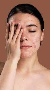 how to cure dark spots here are 5 home