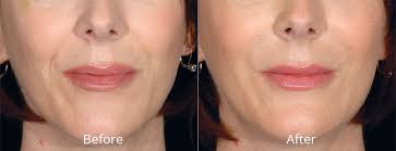 restylane in madison ct lip fillers