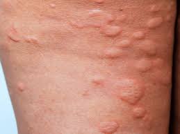 cholinergic urticaria how to get