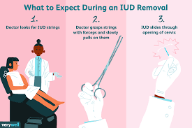 what to expect during your iud removal