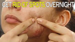 how to get rid of spots overnight and