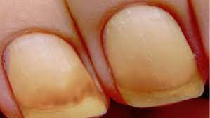 what is yellow nail syndrome causes
