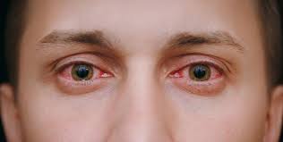 the many causes of chronic red eyes
