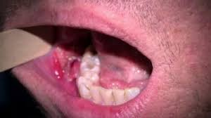 these early symptoms of mouth cancer