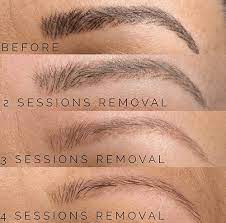 eyebrow tattoo removal permanent