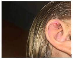 pseudomona chondritis and ear piercing