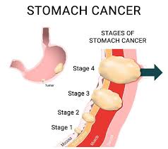 Other symptoms of stomach cancer that get worse or do not get better after 2 weeks. A Case Report On 4th Stage Stomach Cancer Learn Sujok Heal The World