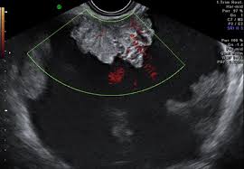 Ovarian cysts are commonly encountered in gynecological imaging, and vary widely in etiology, from pathology small cystic ovarian structures should be considered normal ovarian follicles unless the. New Test Can Help Doctors Choose Best Treatment For Ovarian Cancer Imperial News Imperial College London