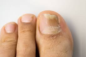 athlete s foot fungal skin infection