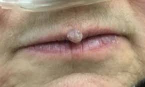 prominent lesion on the upper lip