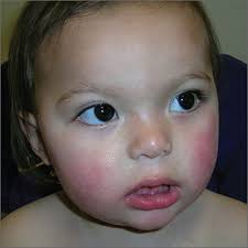 child with malar rash clinician reviews