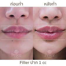 why do lips thin with age peace clinic