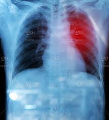 The stomach secretes acid and enzymes that digest food. X Ray Film Of Chest And Stomach Under Dome Of The Diaphragm Red Zone Is Pain Stock Photo 2326ba59 5758 4b3e B8b0 05f48b13df7f