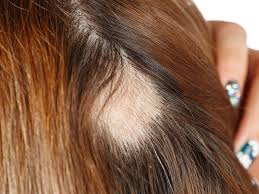 alopecia areata overview types causes