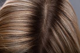 dry irritated scalp could be head
