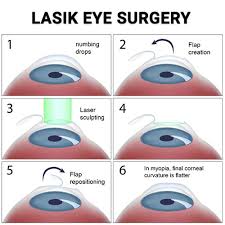 lasik eye surgery in nyc vitreous