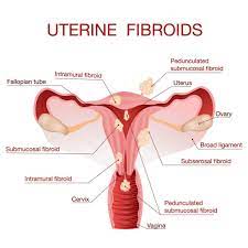 uterine fibroids narikaa com