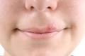 Cold sore Causes - Mayo Clinic