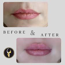 lip filler augmentation in istanbul