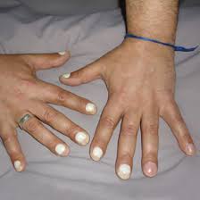 nails and liver disease