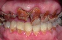 enamel erosion prevention meth dental