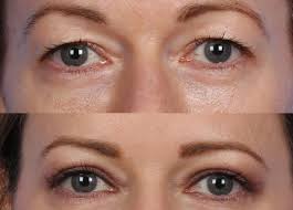 what is hooded eye surgery your