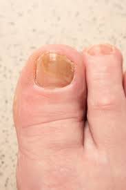 photo toenails with fungal infection